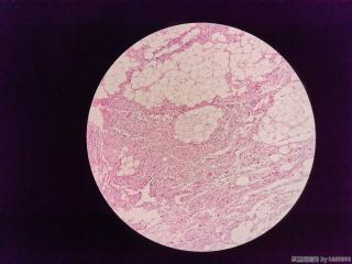 腹股沟肿物（纤维脂肪瘤？）图1