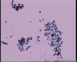 55岁，宫颈液基。图18