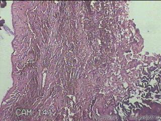 睾丸鞘膜图13