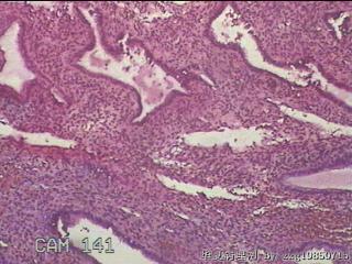 左侧宫腔赘生物图9
