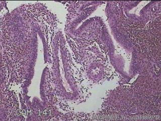 左侧宫腔赘生物图8