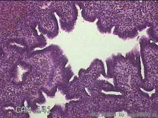 左侧宫腔赘生物图32