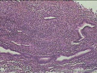 左侧宫腔赘生物图10