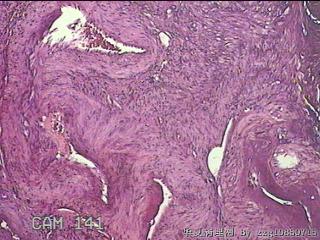 左侧宫腔赘生物图17