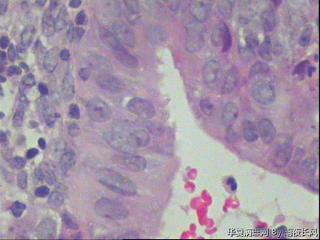 请教，中分化子宫内膜样腺癌？图29