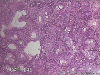 鼻腔新生物图31