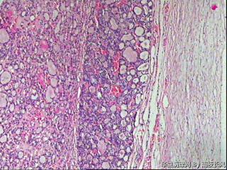 甲状腺滤泡性腺瘤？图9