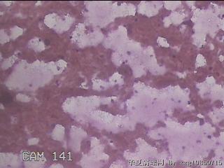 左甲状腺肿物穿刺标本图28