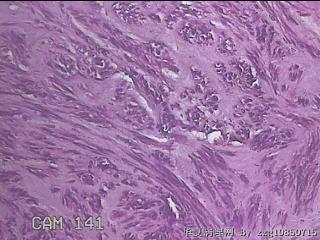 子宫肌瘤图17
