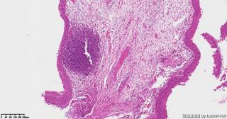 膀胱三角区粘膜，可以诊断滤泡性膀胱炎吗？图3