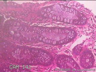 乙状结肠粘膜图23