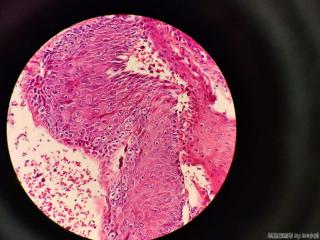 足底裂口不愈、局灶瘤样增生两月，取活检图6