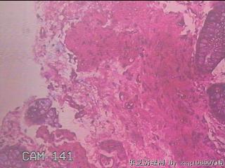 乙状结肠粘膜图20