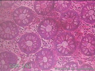 乙状结肠粘膜图19