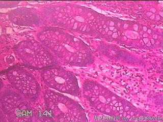 乙状结肠粘膜图14