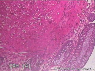 乙状结肠粘膜图25