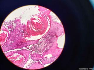 足底裂口不愈、局灶瘤样增生两月，取活检图12