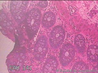 乙状结肠粘膜图21
