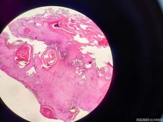 足底裂口不愈、局灶瘤样增生两月，取活检图3