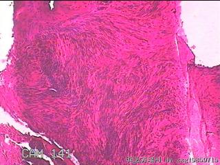 子宫粘膜下肌瘤图21