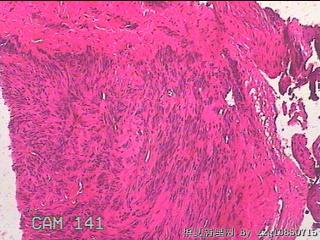 子宫粘膜下肌瘤图17