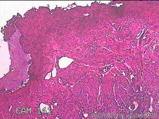 子宫粘膜下肌瘤图25