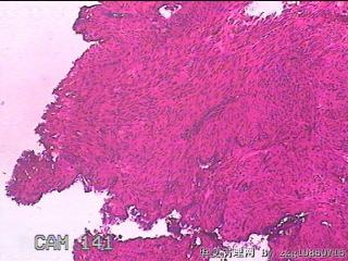 子宫粘膜下肌瘤图22