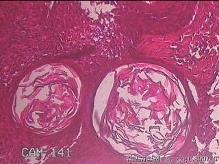 颈部皮肤赘生物图12