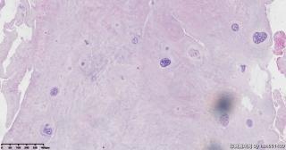 椎间盘组织，请教一个这些梭形细胞是什么组织？图3