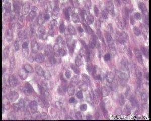 请老师看看子宫内膜增生，间质细胞增生这么严重？图24