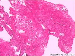 宫颈、尿道口赘生物图15