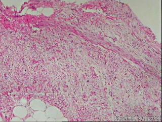 请教，腹膜后肿瘤，硬化性脂肪肉瘤？图1