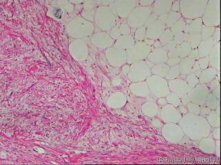 请教，腹膜后肿瘤，硬化性脂肪肉瘤？图4