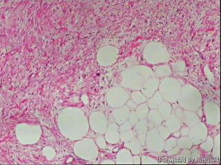 请教，腹膜后肿瘤，硬化性脂肪肉瘤？图3