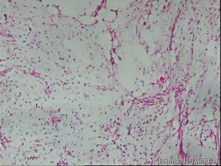 请教，腹膜后肿瘤，硬化性脂肪肉瘤？图29