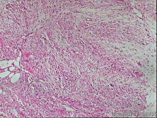 请教，腹膜后肿瘤，硬化性脂肪肉瘤？图25