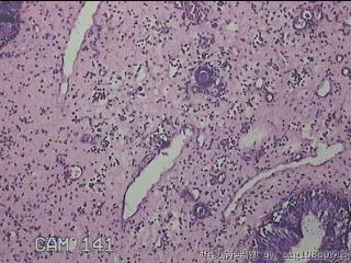 双侧鼻腔新生物图21