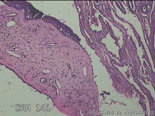 双侧鼻腔新生物图19