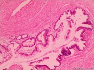 黏液腺瘤？图4