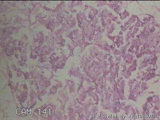 右侧腋窝肿物图32