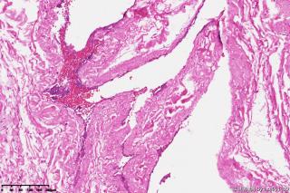 精索鞘膜组织，请教一下这些是增生的间皮细胞吗，有什么临床意义？图2