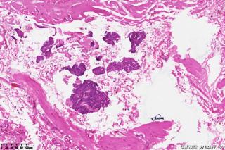 精索鞘膜组织，请教一下这些是增生的间皮细胞吗，有什么临床意义？图8