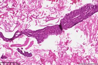 精索鞘膜组织，请教一下这些是增生的间皮细胞吗，有什么临床意义？图6