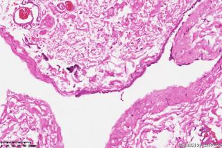 精索鞘膜组织，请教一下这些是增生的间皮细胞吗，有什么临床意义？图4