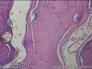 右小腿皮肤赘生物图17