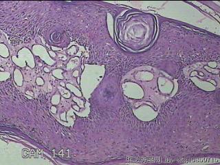 右小腿皮肤赘生物图15