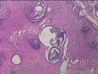 右小腿皮肤赘生物图29