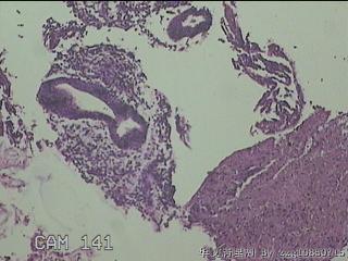左卵巢异位组织图8
