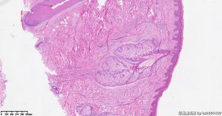 真皮纤维瘤？图8