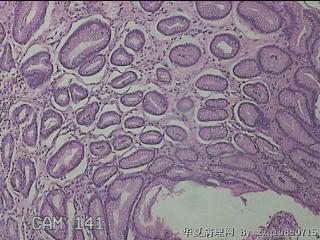 胃窦大弯侧粘膜图4